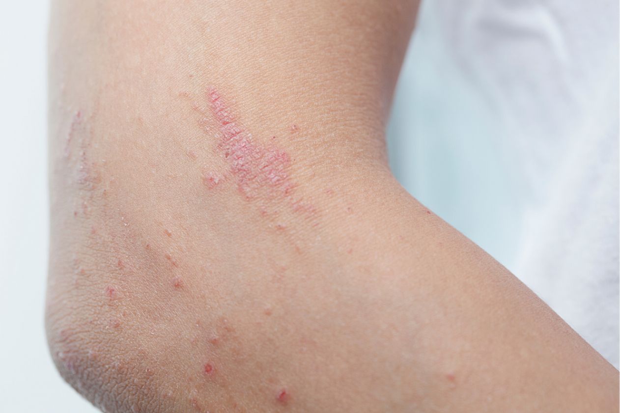 Photo of Most Common Skin Lesions